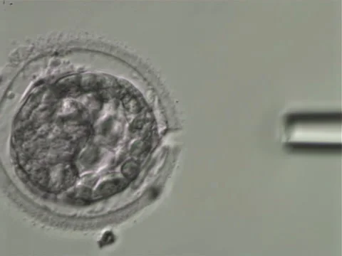 Specialist extracting tissue sample specimen during medical biopsy procedure 스톡 동영상 250783344
