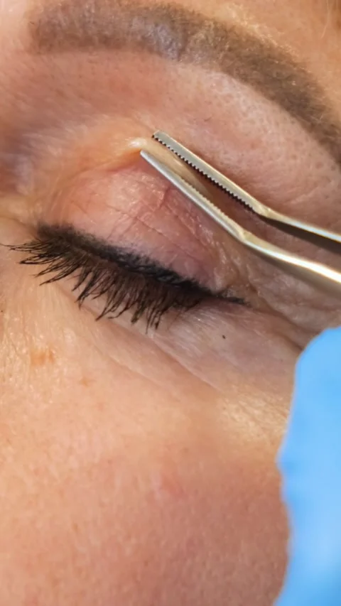 A specialized eye lift procedure that demonstrates the use of plastic surgery Stock Footage 312842166