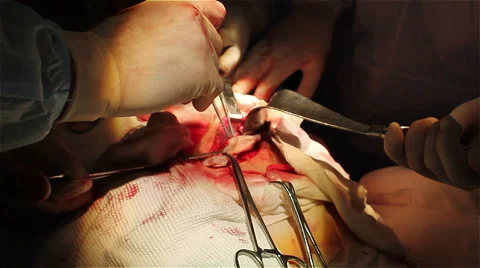 Specialized Team Performing Surgery In Operating Room Stock Footage 40194027