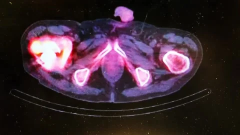 SPECT CT of the Pelvis Showing Bony Anat... | Stock Video | Pond5