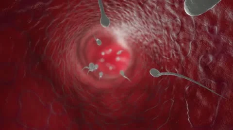 Искусственная инсеминация спермой мужа с использованием катетера Крафта