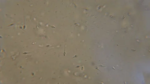 Sperm (spermatozoa) viewed under the microscope. Moving human sperm under Pha Video stock 118764607