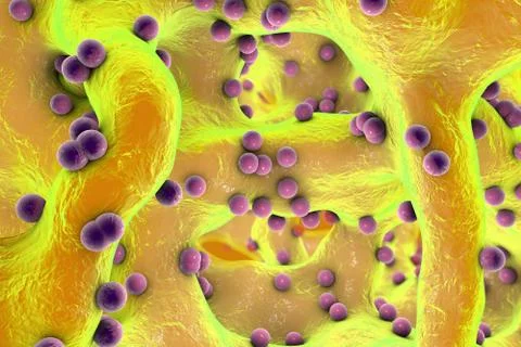 Spherical bacteria inside bone tissue Illustrazione stock