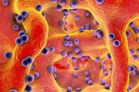 Spherical bacteria inside bone tissue Illustrazione stock