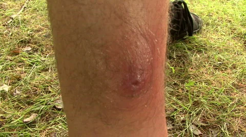Spider Bite 02 Stock Footage 299119