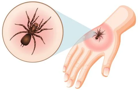 Spider bites sting on skin Stock Illustration