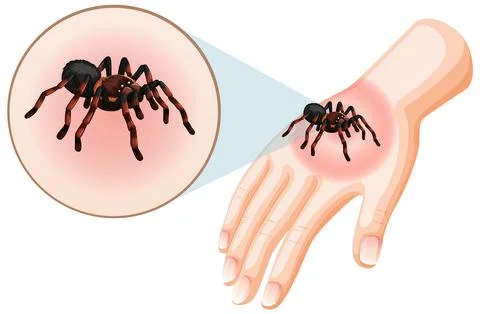 Spider bites sting on skin Stock Illustration