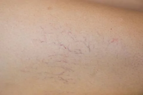 Spider veins on leg. Varicose veins. swelling of the veins on the legs Stock Photos