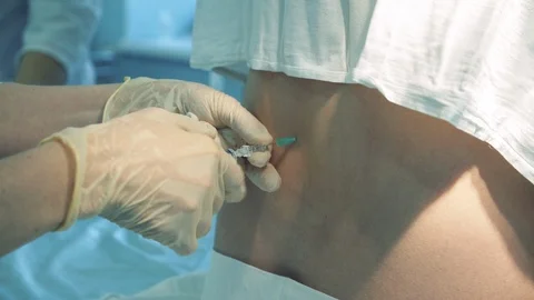 Spinal anesthesia, epidural anesthesia. A needle is being inserted and removed Stock Footage 126569450