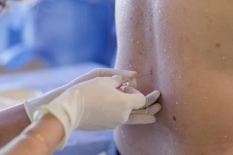 Spinal Anesthesia Procedure with Needle Insertion on Patient's Back Stock Photos