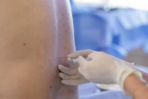 Spinal Anesthesia Procedure with Needle Insertion on Patient's Back Stock Photos