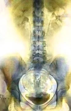  SPINAL COLUMN, X-RAY X-ray of the pelvis and lower back of a 25 years old... Stock Photos