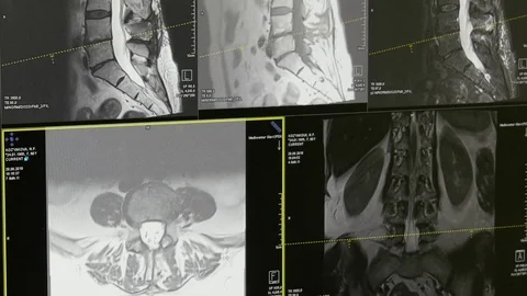 Spinal Mri Stock Videos – Royalty-Free HD & 4K Videos