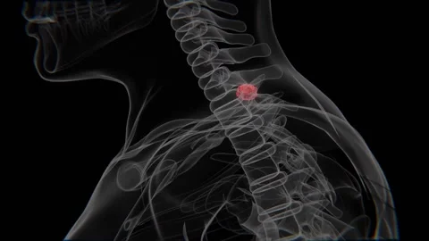 Spinal Cord Tumors in Upper spinal cord in Vertical HQ Video | Spinal Cord Stock Footage 330924131