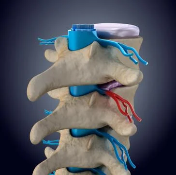 Spinal cord under pressure of bulging disc Stock Illustration