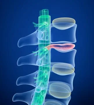 Spinal cord under pressure of bulging disc, X-Ray view.  3D illustration Stock Illustration