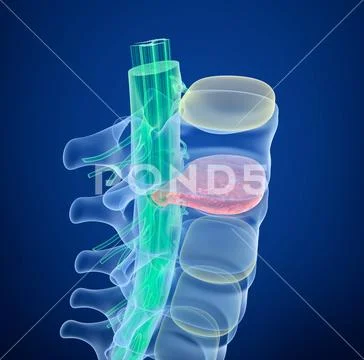 Spinal cord under pressure of bulging disc, X-Ray view. 3D illustration Stock Illustration