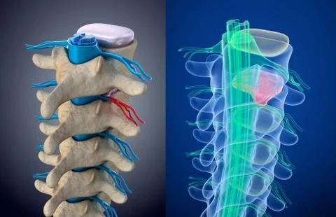 Spinal cord under pressure of bulging disc. Xray view. Medically accurate 3.. Stock Illustration