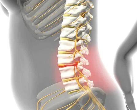 Spinal disc herniation, back pain, 3d illustration Stock Illustration