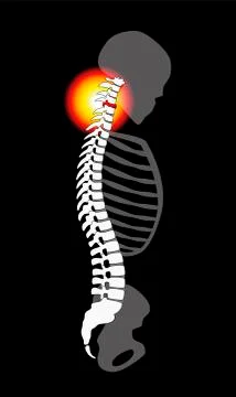 Spinal Disc Prolapse Neck Pain Cervical Vertebrae Stock Illustration