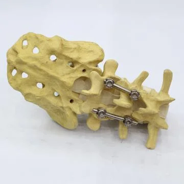 Spinal fixation system - titanium bracket Stock Photos