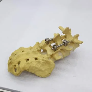 Spinal fixation system - titanium bracket Stock Photos