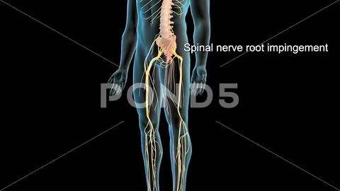 Spinal nerve root impingement - 3D illustration ~ Clip Art #221340947