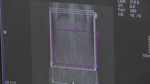 Spinal tomography Stock Footage 130793918