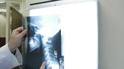 Spinal X-Ray Vidéo 31554982