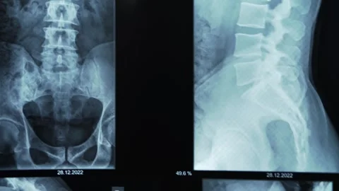 Spinal X Ray Images Prepared for Clinical Evaluation 動画素材 340666971