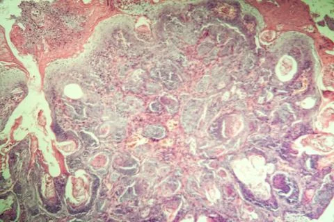 Spinaliom Stock Photos