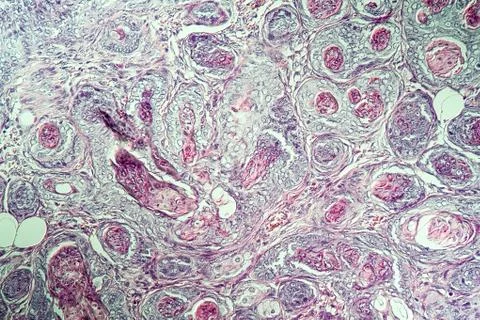 Spinaliom Stock Photos