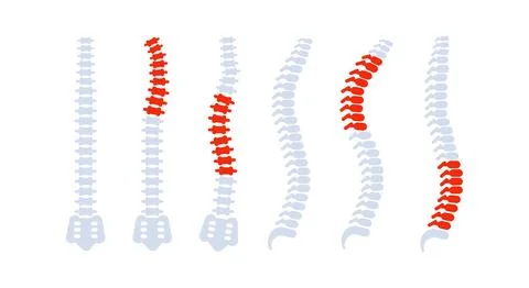Spine bones with back pain highlighted showing different problems Stockillustratie