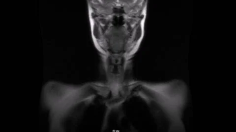 Spine cervical MR SR MRI tomography Vídeo Stock 196876715