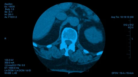 Spine computer tomography result visualization Stock Footage 125429743