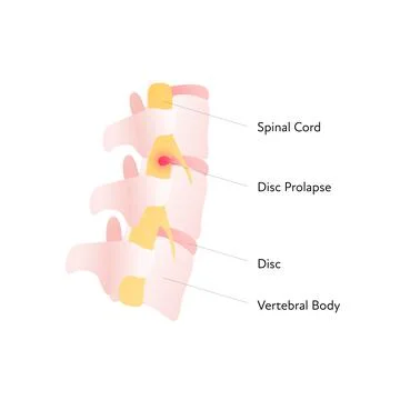 Spine cord vector flat anatomical illustration with text and disc prolapse. Illustrazione stock