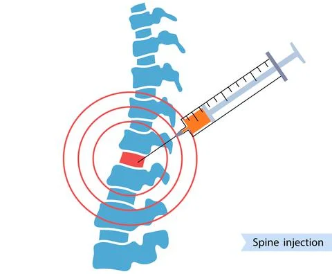Spine joint injection Stock Illustration