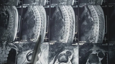 Spine MRI sagittal sections on lightbox with doctor's hand pointing, medical Vídeos de archivo 302042709