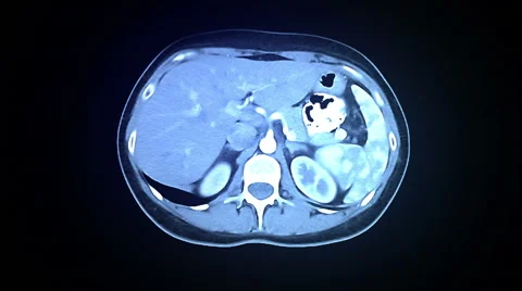 Spine MRI Scan Stock-Footage 63208944