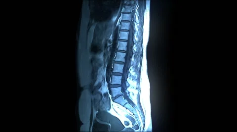 Spine MRI Scan Stock-Footage 63208979