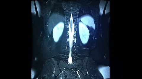 Spine MRI Scan Stock-Footage 63209018
