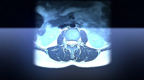 Spine MRI Scan 動画素材 63209221