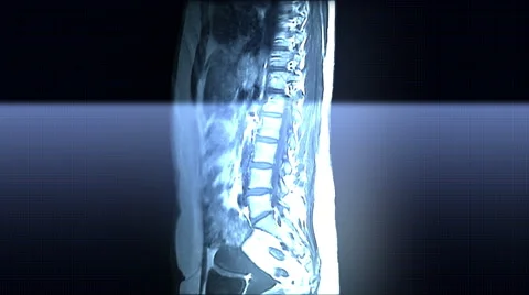 Spine MRI Scan Stock-Footage 63209238