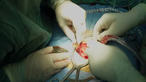 A spine surgeon performing surgery in the operating room Stock Footage 151461433