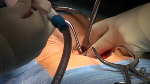 Spine surgery  close up Stock Footage 115590287