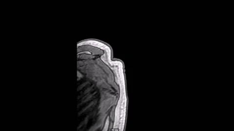 Spine thoracic MR SR MRI tomography 库存影片 196876702