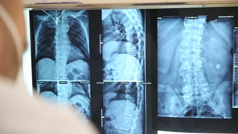 Spine  x-ray 1 Video stock 317083529
