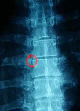 Spine xray with circle Stock Photos