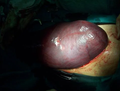 Splenectomy Stock Photos