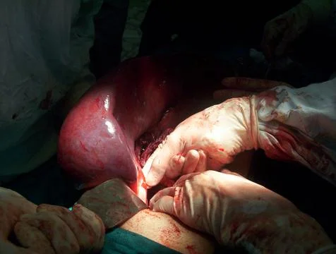 Splenectomy Stock Photos